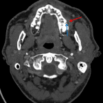 Red arrow: small subperiosteal abscess. Blue arrow: cortical breakthrough associated with periapical lucency of the left first maxillary molar.