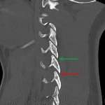 Red arrow: widened right C5-C6 facet joint. Green arrow: adjacent normal facet joint for comparison.