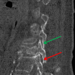Red arrow: subtle facet joint widening. Green arrow: adjacent normal facet joint for reference.