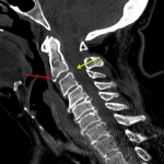 Red arrow: teardrop fracture. Yellow arrow: central disc herniation.