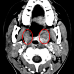 Red ovals: striated appearance of the palatine tonsils bilaterally consistent with tonsillitis.