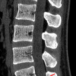 Red arrow: age-indeterminate L5-S1 disc herniation.
