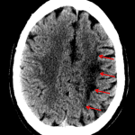 Red arrows: linear infarct along the ACA/MCA watershed zone
