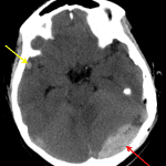 Red arrow: acute epidural hematoma. Yellow arrow: small contrecoup cerebral contusion.