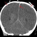 Red arrows: acute subdural hematomas layering along the bilateral cerebral convexities and along the interhemispheric falx.