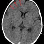 Red arrows: thin CSF density right frontal collection - either a chronic subdural hematoma (which is likely the case here given concern for nonaccidental trauma) or hygroma.