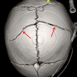 Biparietal (red arrows) and occipital (yellow arrow) fractures.