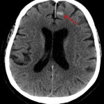 Red arrow: small volume acute traumatic subarachnoid hemorrhage.