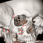 Red arrows: ZMC fracture with fractures through the lateral orbital floor extending through the zygomaticofrontal suture, orbital floor and anterior wall of the maxillary sinus, and zygoma/zygomatic arch.