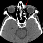 Red arrow: posttraumatic left dacryocystocele in this patient on 3 month follow-up imaging.