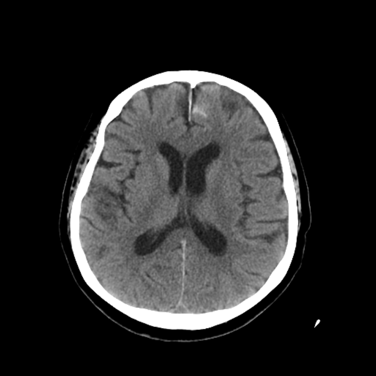 Emergency Neuroimaging – Spine