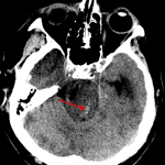 Red arrow: Duret hemorrhage in the pons.