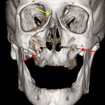 Red arrows: horizontal fracture through the maxilla bilateral, consistent with Le Fort type I fractures. Yellow arrow: fracture involving the right medial orbital wall extending to the nasal arch and nasofrontal suture, consistent with additional right Le Fort type II fracture.