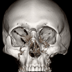 3D rendering showing the extensive facial fractures with craniofacial dissociation on the right.