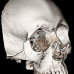 3D rendering showing the extensive facial fractures with craniofacial dissociation on the right.