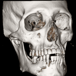 3D rendering of this patient's mandibular fracture.