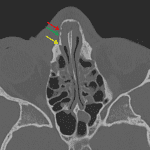 Red arrow: nondisplaced nasal bone fracture. Green arrow: nasomaxillary suture. Yellow arrow: displaced fracture at the base of the frontal process of the maxilla.