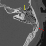 Red arrow: longitudinal temporal bone fracture component. The transverse component is not seen on this axial cut. Yellow arrow: the ice cream is sliding off the cone = malleoincudal dislocation.