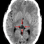 Red arrows: peripherally calcified low density pineal lesion, likely a pineal cyst.