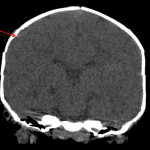 Red arrow: linear hyperdensity near the fracture, likely streak artifact. Notice the multiple artifactual skull stepoffs related to patient motion and not a calvarial fracture.