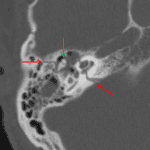 Acute transverse, otic capsule involving right temporal bone fracture in this patient, which extends through the cochlea. Green arrow shows the normal ice cream cone appearance of the malleoincudal joint.