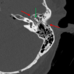 Acute longitudinal, otic capsule sparing left temporal bone fracture in this patient, which extends through the middle ear. Green arrow shows the normal ice cream cone appearance of the malleoincudal joint.