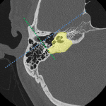 Review of temporal bone anatomy: blue dotted line = plane of longitudinal fractures, green dotted line = plane of transverse fractures, and yellow shaded in area = the otic capsule.