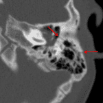 Red arrows: acute longitudinal, otic capsule sparing left temporal bone fracture in this patient, which extends from the mastoid process into the middle ear.