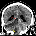Red arrow: upward transtentorial herniation Yellow arrow: right cerebellar tonsillar herniation.