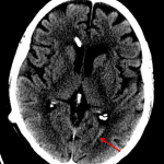 Red arrow: trace acute intraventricular hemorrhage (IVH) in the left occipital horn.