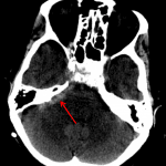Red arrow: small volume acute subarachnoid hemorrhage in the right CP angle cistern.