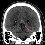 Red arrow: thin subdural hemorrhage along the left cerebellar tentorium. Coronals are helpful when looking for subtle blood on the tentoria since they facilitate side-to-side comparison.
