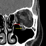 Partially herniated inferior rectus through the minimally displaced orbital floor fracture with a markedly narrowed muscle between the intraorbital (red arrow) and herniated (yellow arrow) components.