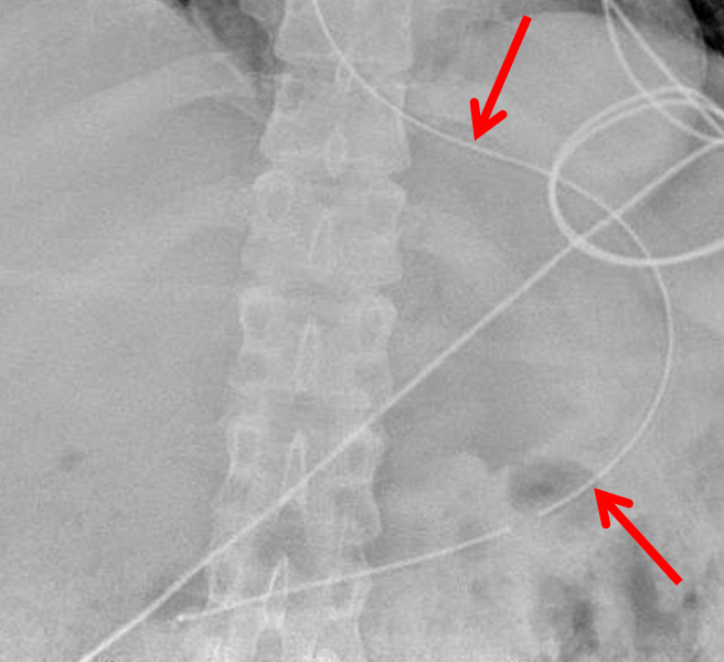 Nasogastric and Orogastric Tubes