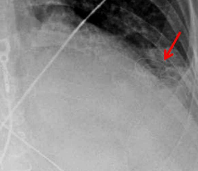 Diaphragmatic Pacing Wires
