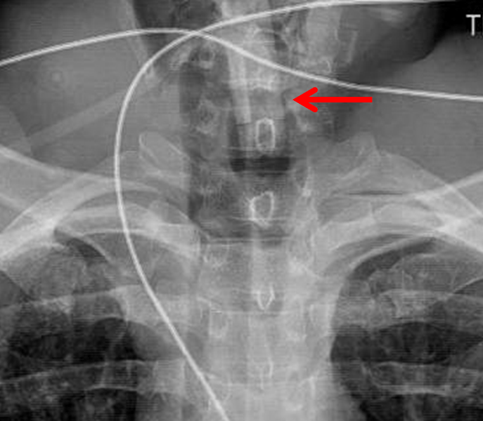 Esophageal Intubation Device