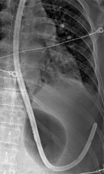 Blakemore/Minnesota Tube