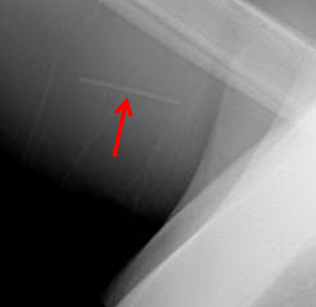 Subcutaneous Contraceptive Device