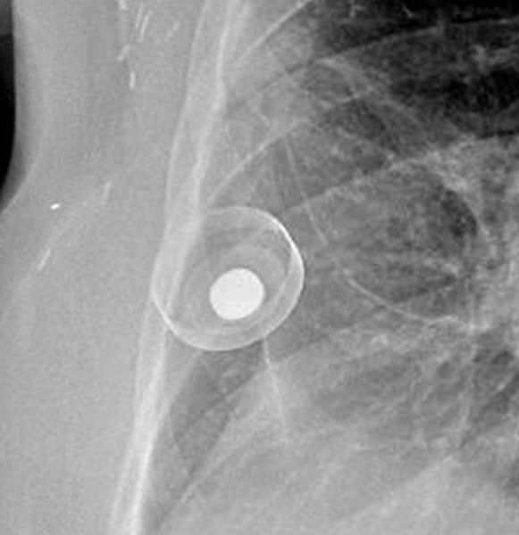 Breast Tissue Expander