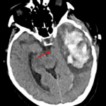 Red arrows: medial deviation of the left temporal lobe uncus, consistent with uncal herniation.