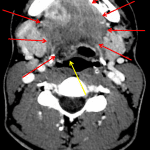Fluid extending along the right floor of the mouth (red arrows). Mass effect on the oropharynx (yellow arrow).