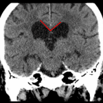 Red lines: borderline narrow callosal angle in this patient