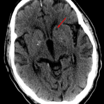Red arrow: lacunar infarct in the left caudate head.