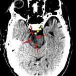 Red arrows: area of acute/early subacute ischemia in the right hemipons. Yellow arrow: hyperdense appearance of the basilar artery concerning for thrombosis.