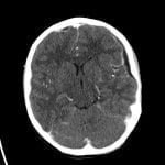 Left cerebral convexity and medial right frontal subdural empyemas.