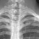 Coracoclavicular distance is normal on the right (11 mm) and increased on the left (20 mm).
