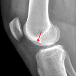 Red arrow: deep lateral condylar notch.