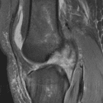 Subsequent MRI in this patient shows complete ACL tear.