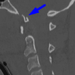 Blue arrow: displaced occipital condyle fracture.
