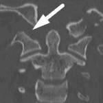 White arrow: widening of the right atlanto-occipital articulation.